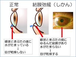 結膜弛緩症