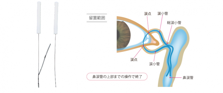 涙道チューブ